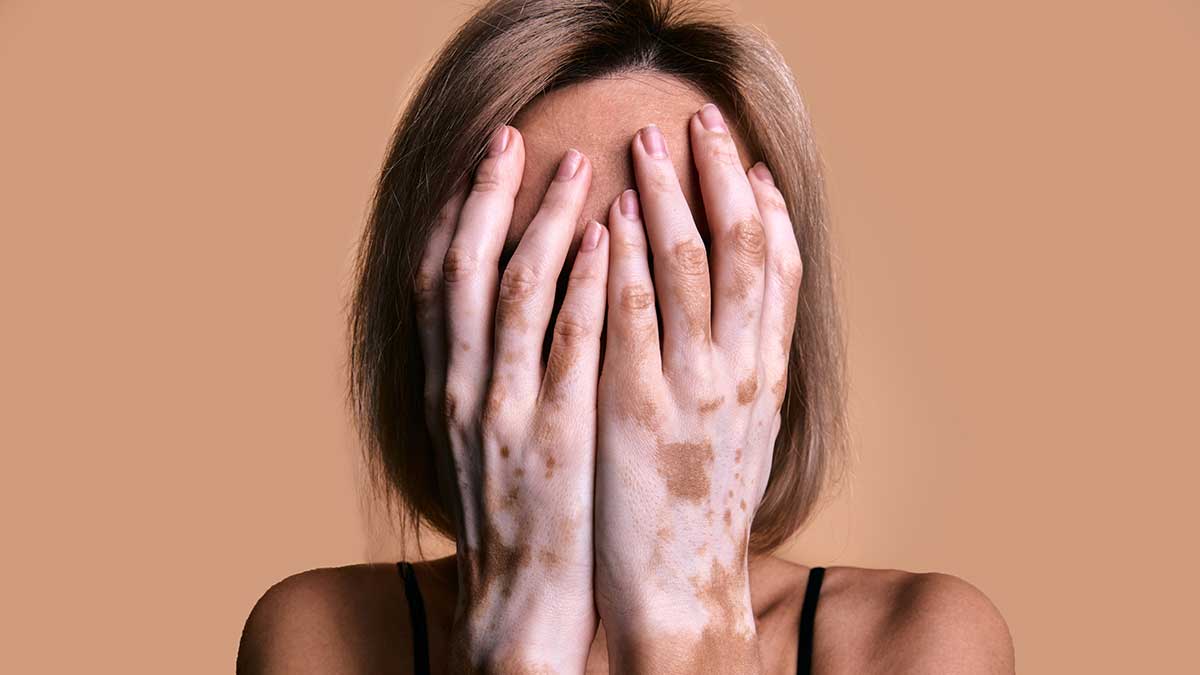 Fehér foltok a bőrön - vitiligo, mint betegség